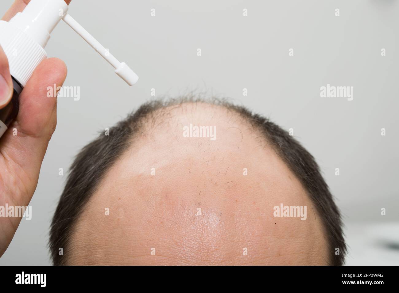 Der Kopf eines Glatzköpfchens mit einem Haarwuchsmittel. Androgenetische Alopezie. Stockfoto