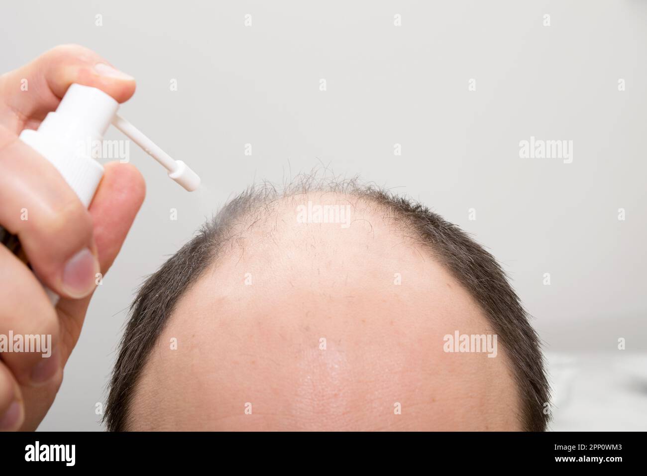 Der Kopf eines Glatzköpfchens mit einem Haarwuchsmittel. Androgenetische Alopezie. Stockfoto