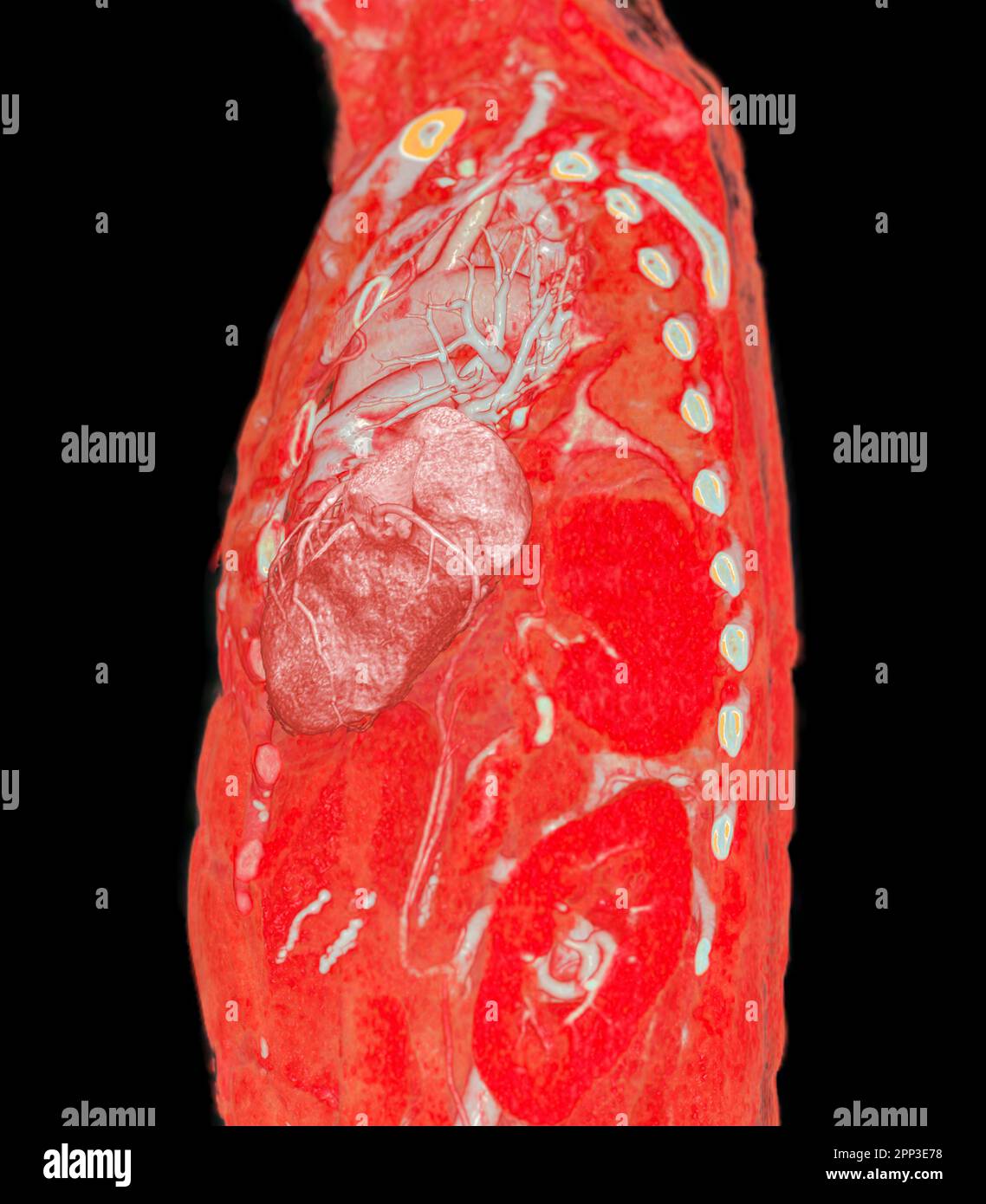 CTA-Pulmonalarterien 3D, Darstellung des Astes der Pulmonalarterie Stockfoto