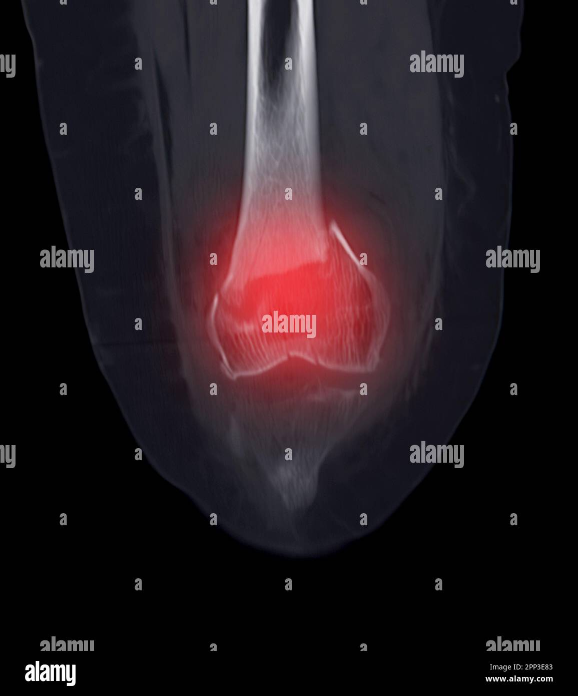 CT-Scan des Kniegelenkes mit Fraktur des distalen Femurknochens. Stockfoto