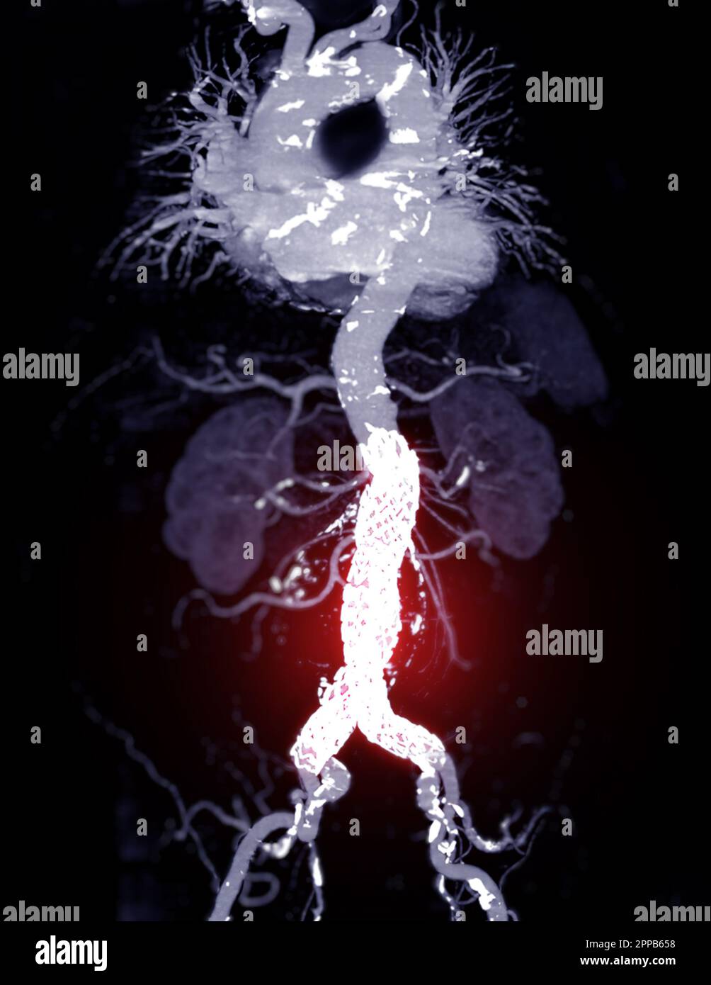 CTA-Ganzaorta mit abdominalem Aortenstent-3D-Rendering bei abdominellen Aortenaneurysmen. Stockfoto