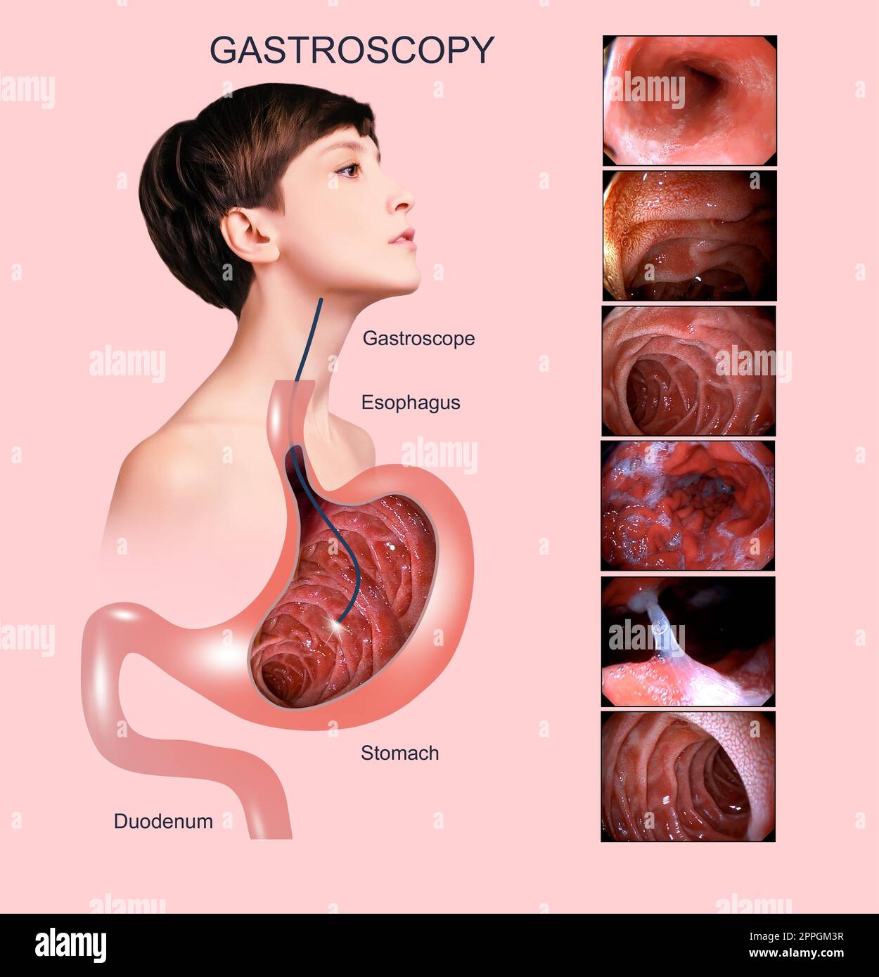 Verdauungsendoskopie oder Gastroskopie. Durchführung einer Gastroskopie. Diagnostik von Magenerkrankungen. Magengesundheit. Stockfoto