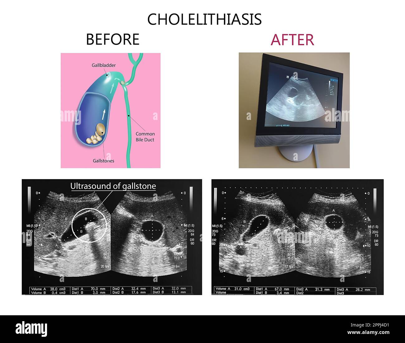 Sonographische Darstellung der Gallenblase mit Gallensteinen im Oberbauch. Gallensteinkonzept Stockfoto