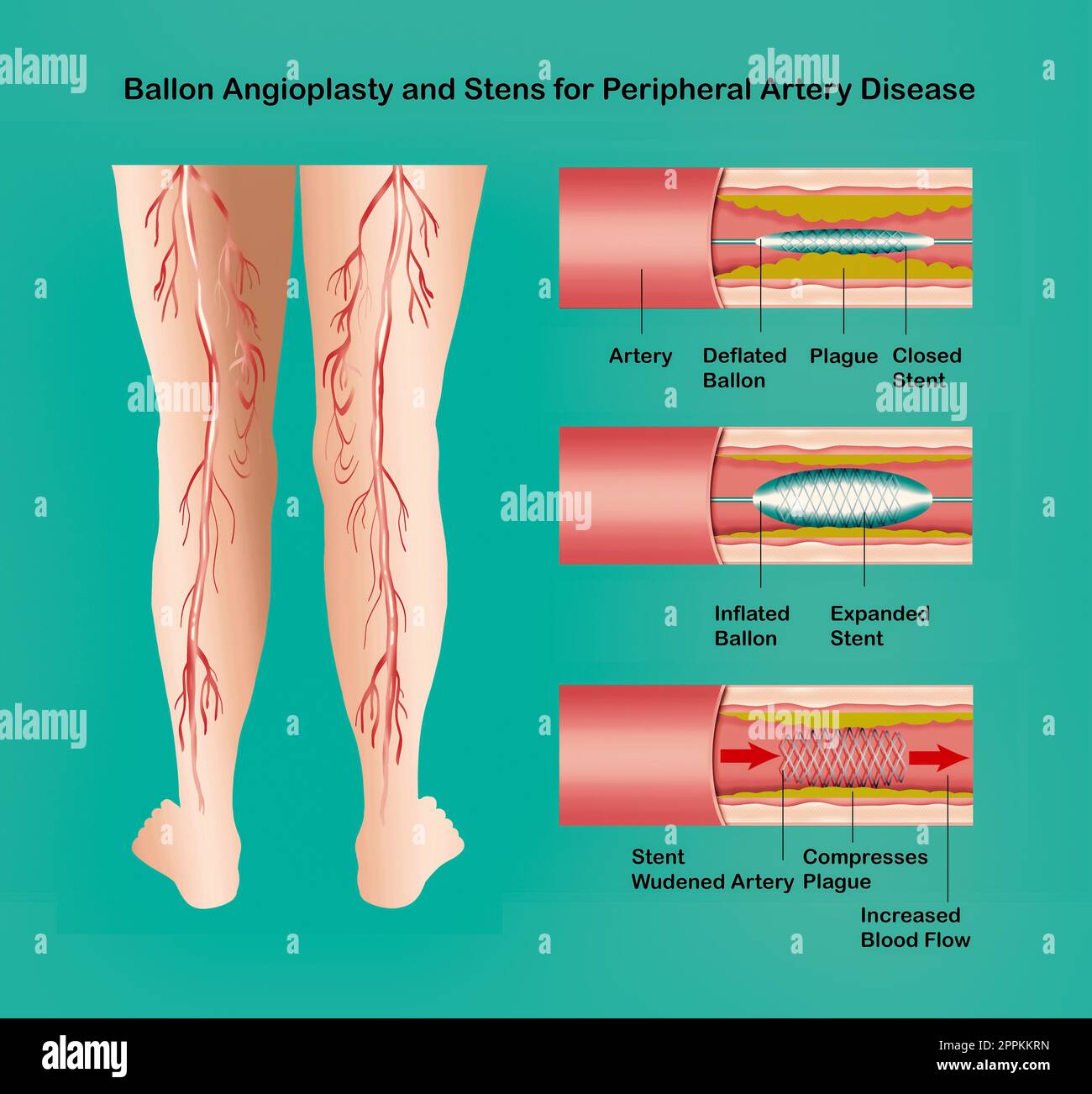 Das Diagramm zeigt Angioplastie für periphere Arterie Krankheit