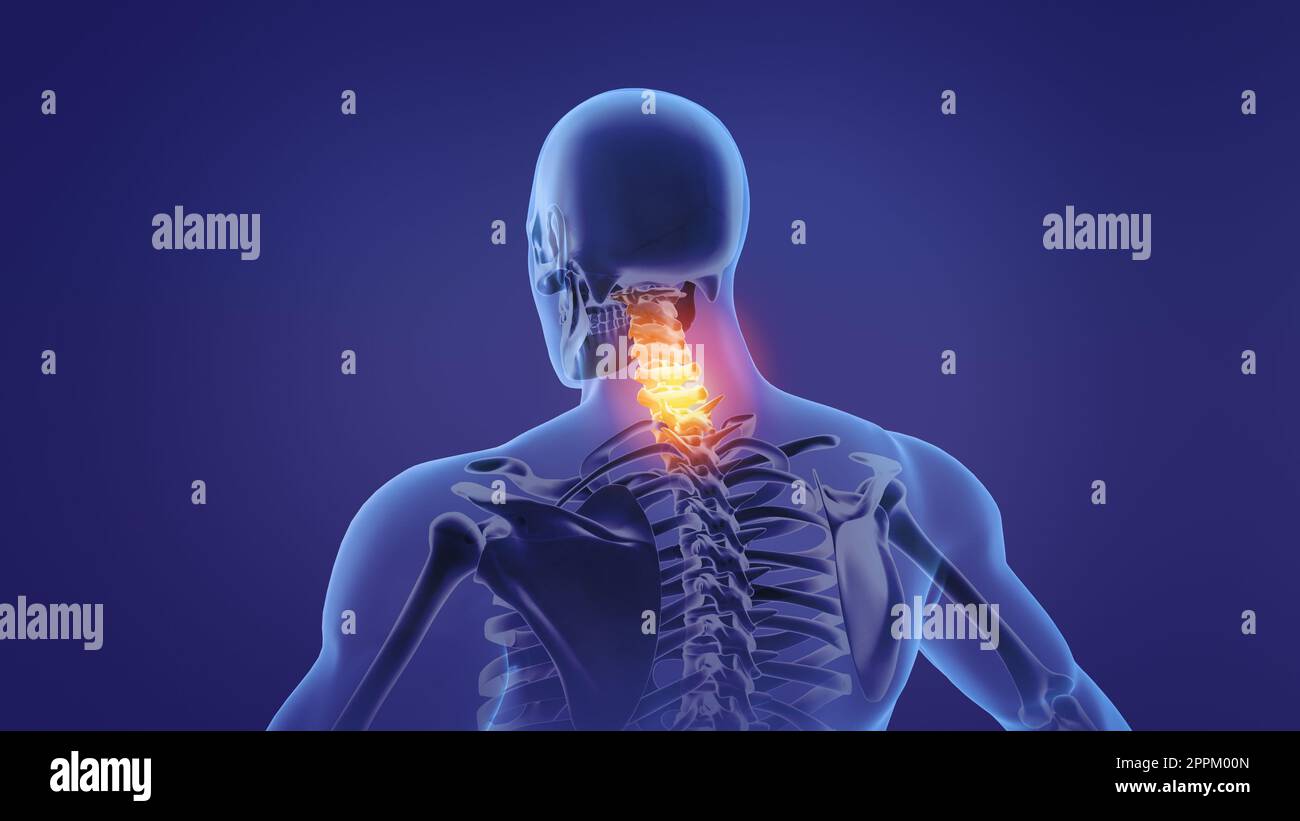 Animation eines schmerzhaften Nackens Stockfoto