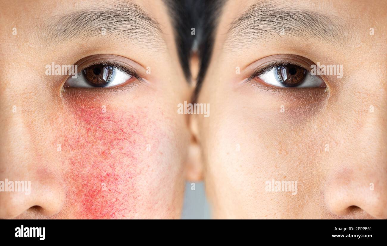 Vor und nach einer Behandlung der akneiformen Rosazea bei einem asiatischen männlichen Gesicht. Couperose auf den Wangen und eines jungen asiatischen Mannes Stockfoto