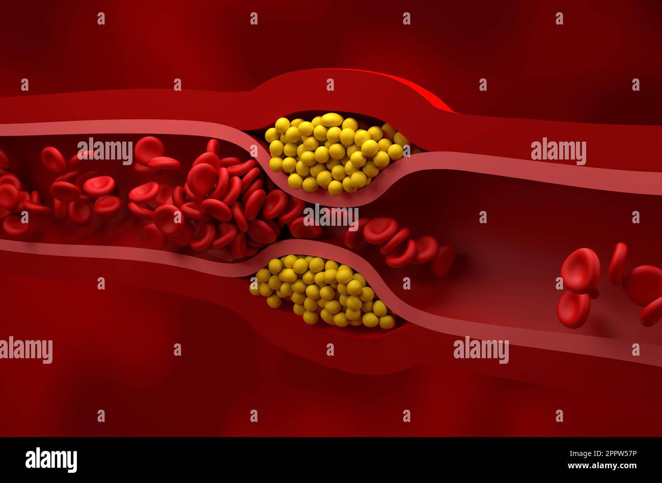 Teilweise blockiertes Gefäß bei hohem LDL-Lipoproteinspiegel (schlechtes Cholesterin) - isometrische Darstellung 3D Stockfoto