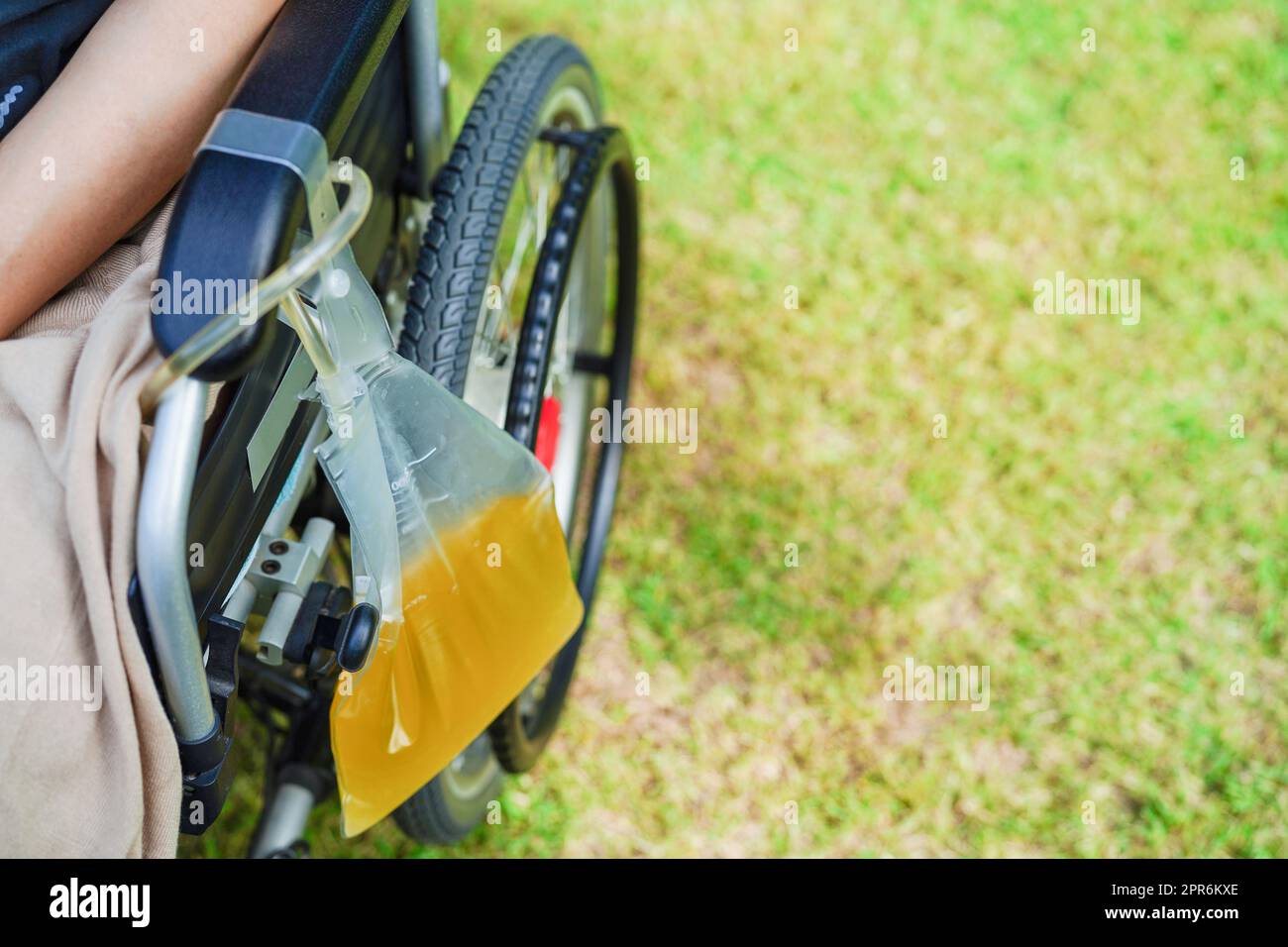Asiatische behinderte Frau mit Urinbeutel auf Rollstuhl. Stockfoto