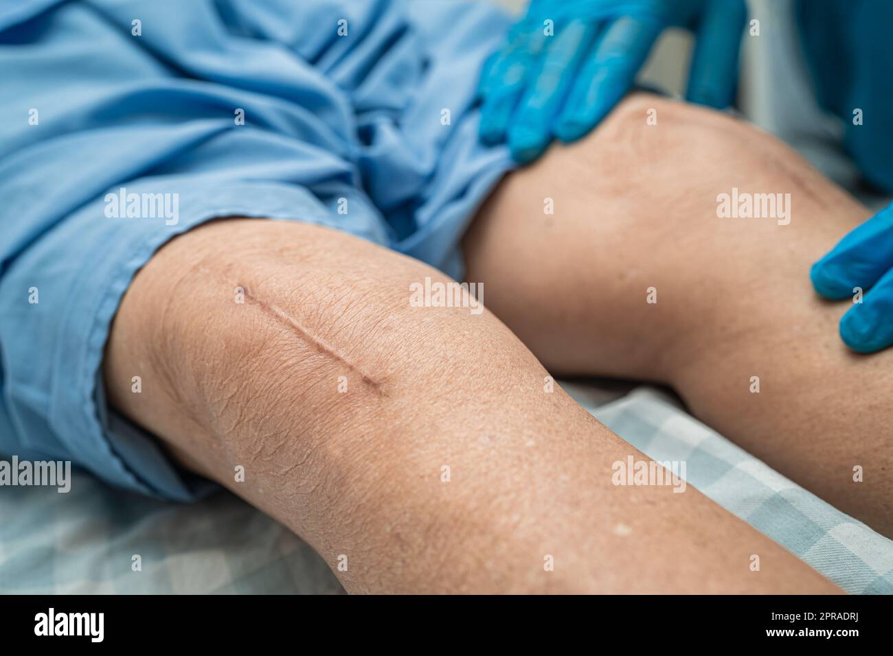 Asiatische ältere oder ältere alte Dame Frau Patientin zeigen ihre Narben chirurgischen totalen Kniegelenkersatz Naht Wundchirurgie Arthroplastik auf dem Bett in Krankenpflege-Station, gesund starke medizinische Konzept. Stockfoto