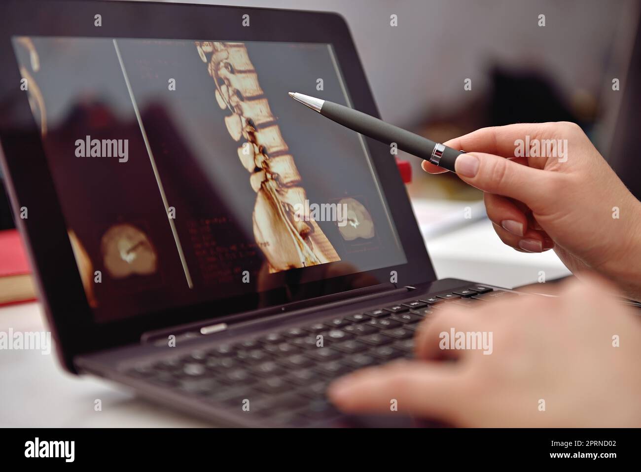 Arzt zeigt auf dem Laptop-Bildschirm auf Röntgenbild des Patienten. Schließen Stockfoto