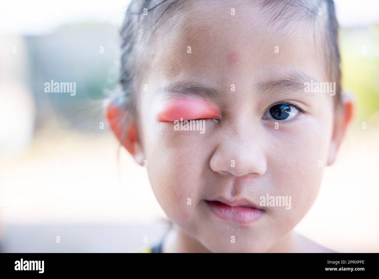 Augenkrankheiten des Sties. Geschlossenes asiatisches Kind kleines Mädchen Auge mit sty, Augenlid Abszess ophthalmic hordeolum Stockfoto