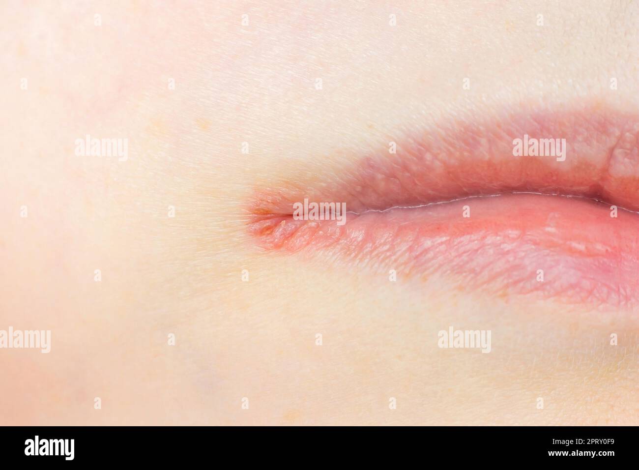 Frau Lippen Haut mit Herpes labialis Virus Nahaufnahme. Stockfoto