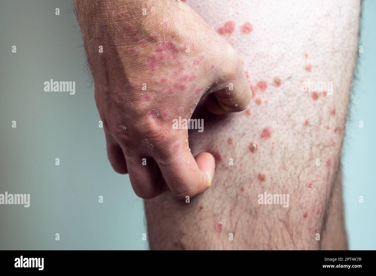 Nicht erkennbarer Mann, der an Psoriasis leidet, an dicken schuppigen Büscheln kratzt, an entzündeten Ausschlägen auf der Beinhaut mit betroffenen Fingern auf weißem Hintergrund leidet. Stockfoto