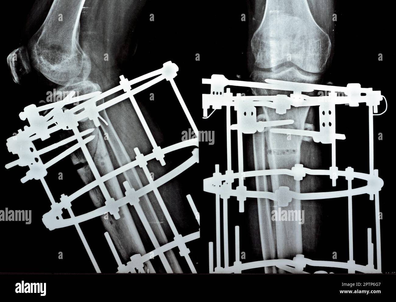 Distale Trümmerfibula mit Platte und Schrauben, distale Tibia mit äusserem Ringfixateur ILIZAROV-Rahmen und sklerotischer Knochenresektion Stockfoto