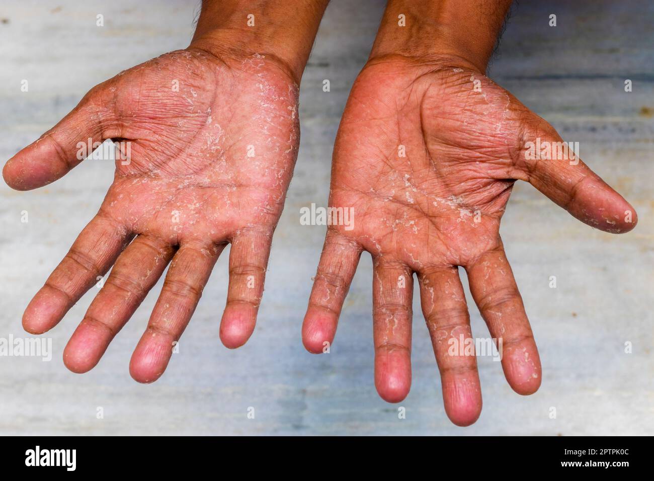Exfoliative Keratolyse, fokale palmarschälende Hauterkrankung. Stockfoto