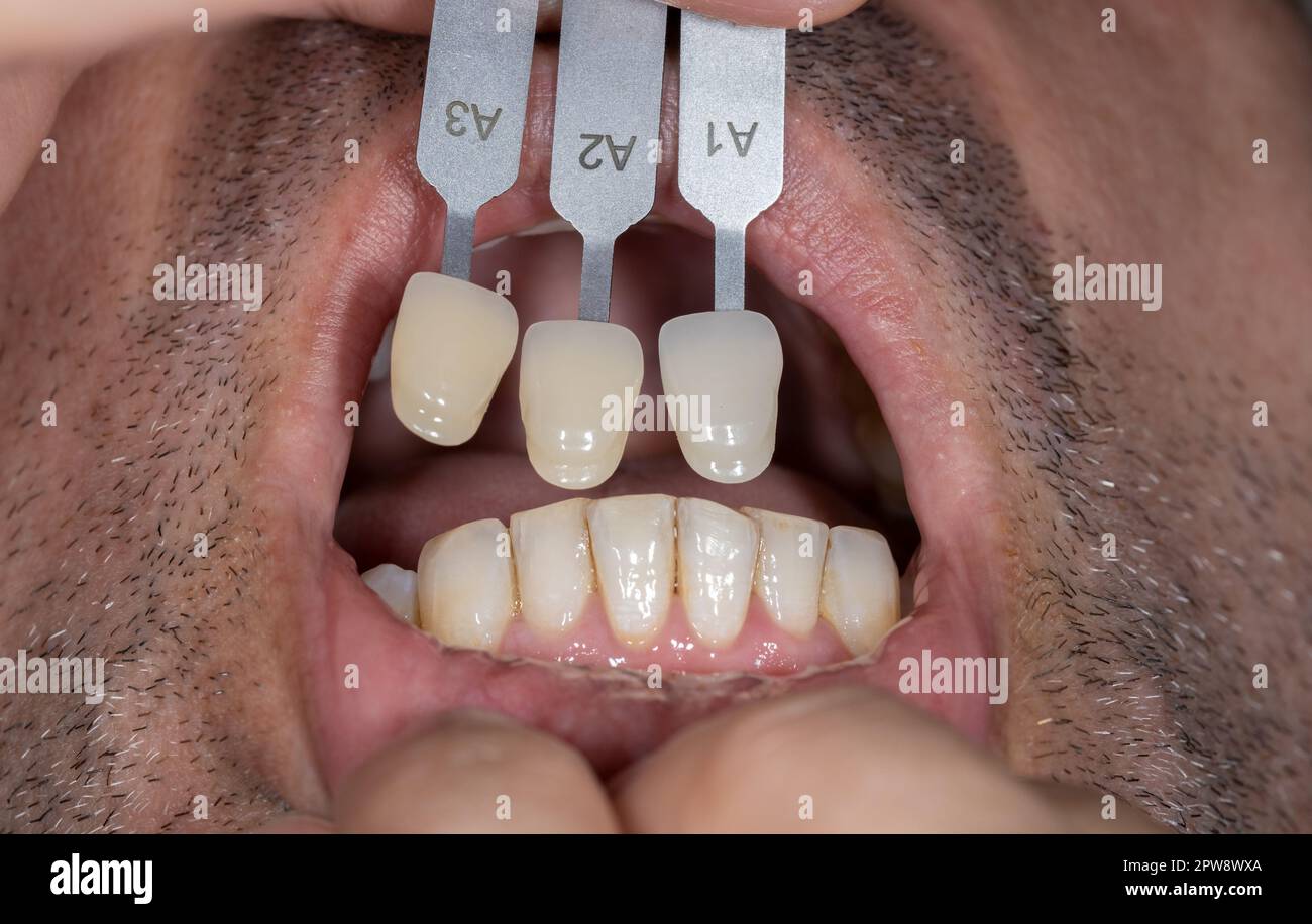 Nahaufnahme des Mundes. Arzt passt Zahnfarbe mit Farbpalette an. Ästhetische Zahnheilkunde Stockfoto