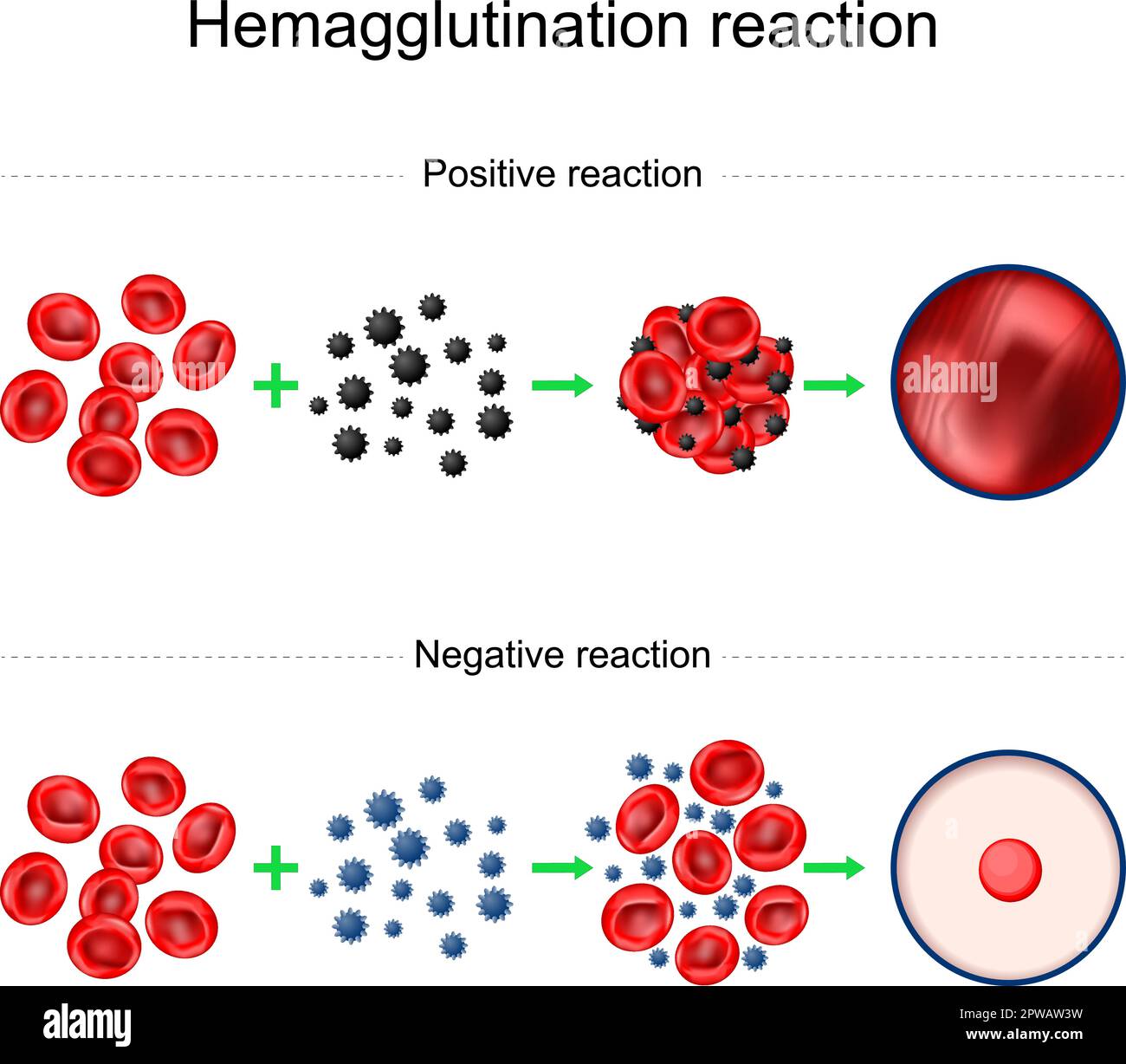 Die Hämagglutinationsreaktion. Blutgruppenbestimmung. Negative und positive Reaktion. Agglutinationstest. Labor Stock Vektor