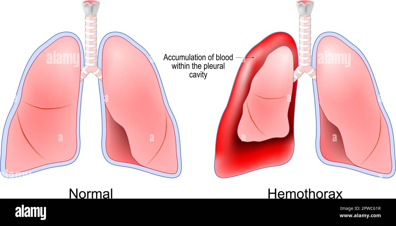 Der Hämothorax. Gesunde menschliche Lungen und rote Lungen nach Blutansammlung in der Pleurahöhle. Thoraxtrauma. Lungenemboliebehandlung Stock Vektor