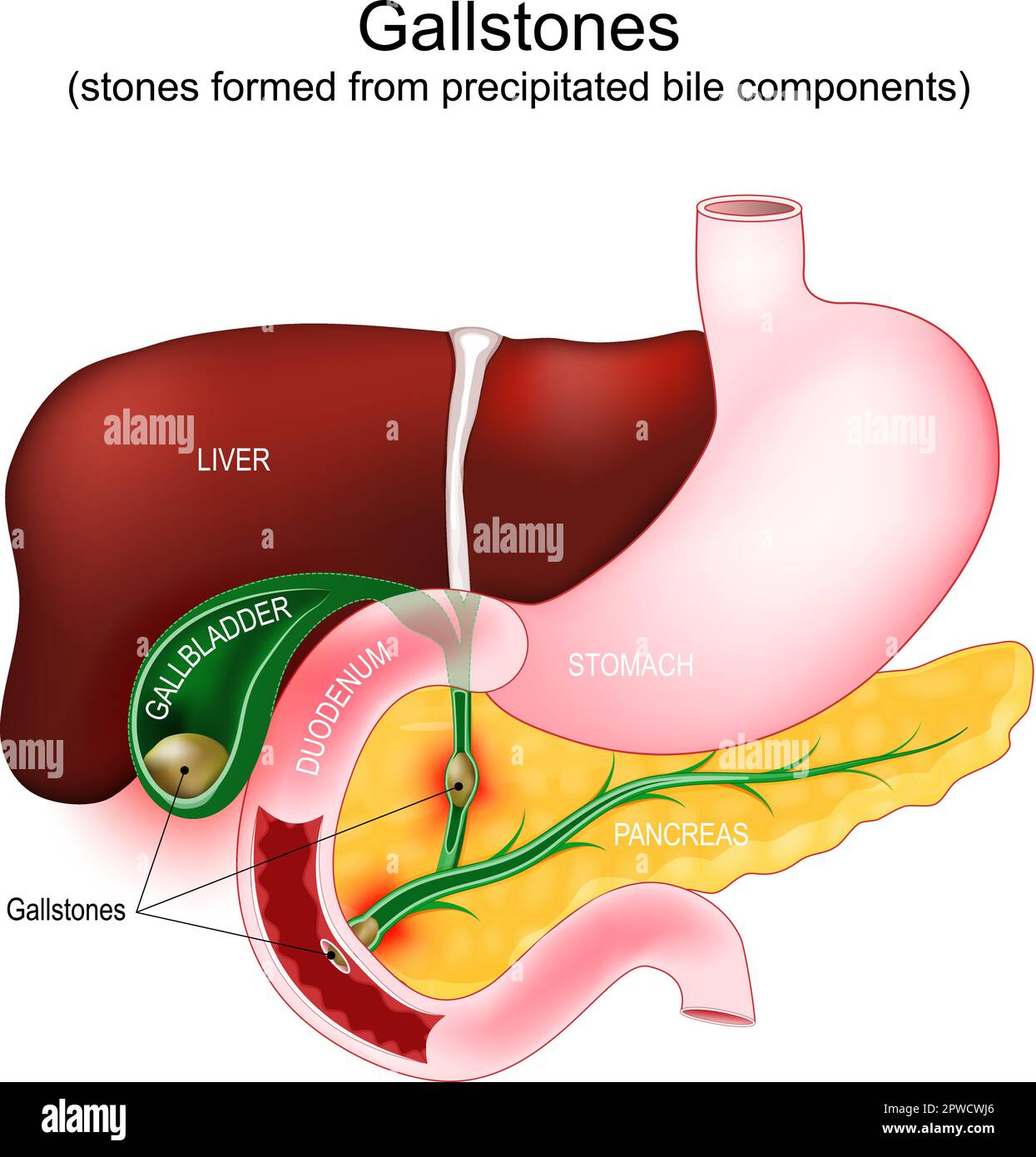 Gallensteine. Cholezystolithiasis bei Stein in der Gallenblase, Choledocholithiasis - Gallenstein blockiert einen Gallengang. Teile eines Verdauungssystems Stock Vektor