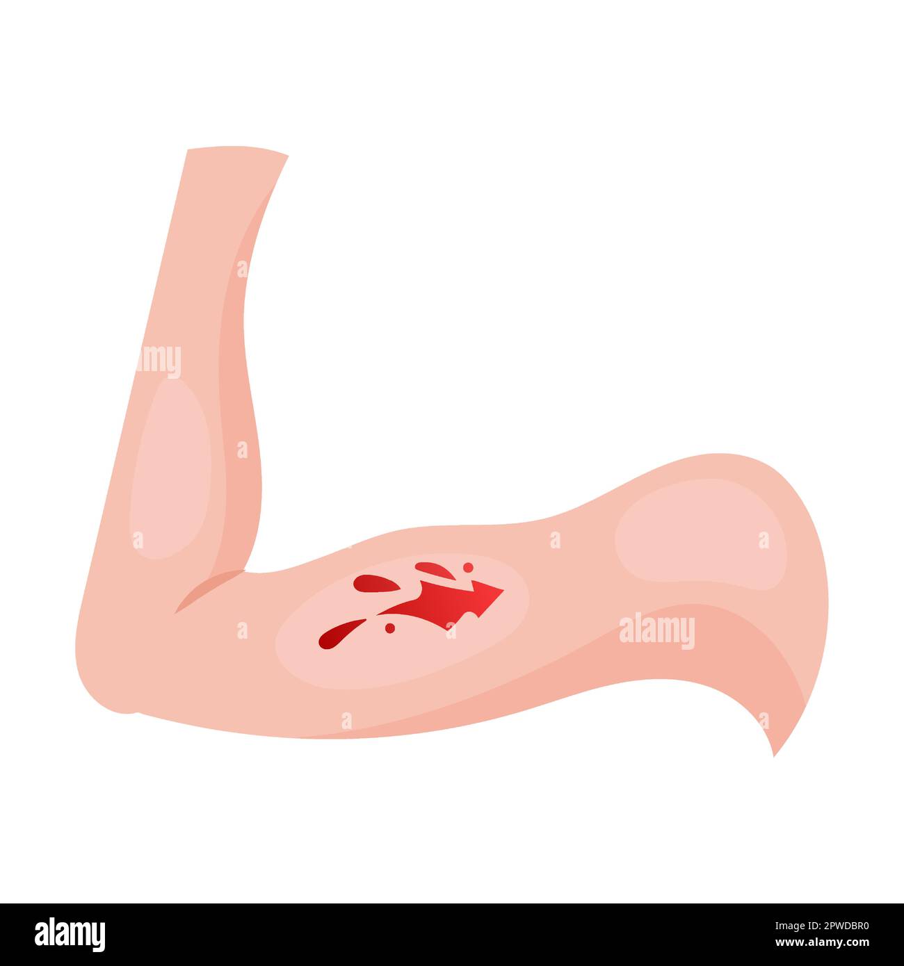 Offene Wunde am Arm. Traumen der Haut am Körperteil. Vektordarstellung offener Schnittwunden mit Blutungen, Frakturen und Blutergüssen Stock Vektor