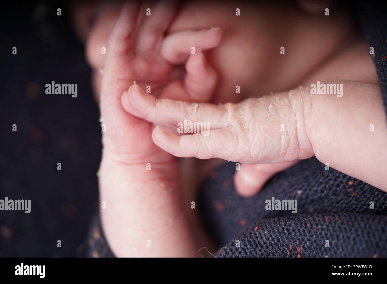 Ein kleines süßes Baby, geboren eine Woche alt. Neugeborenen-Peeling. Hände und Gesichtshaut des Neugeborenen mit Hautablösungen. Nahaufnahme der Hände Details des Neugeborenen. Stockfoto