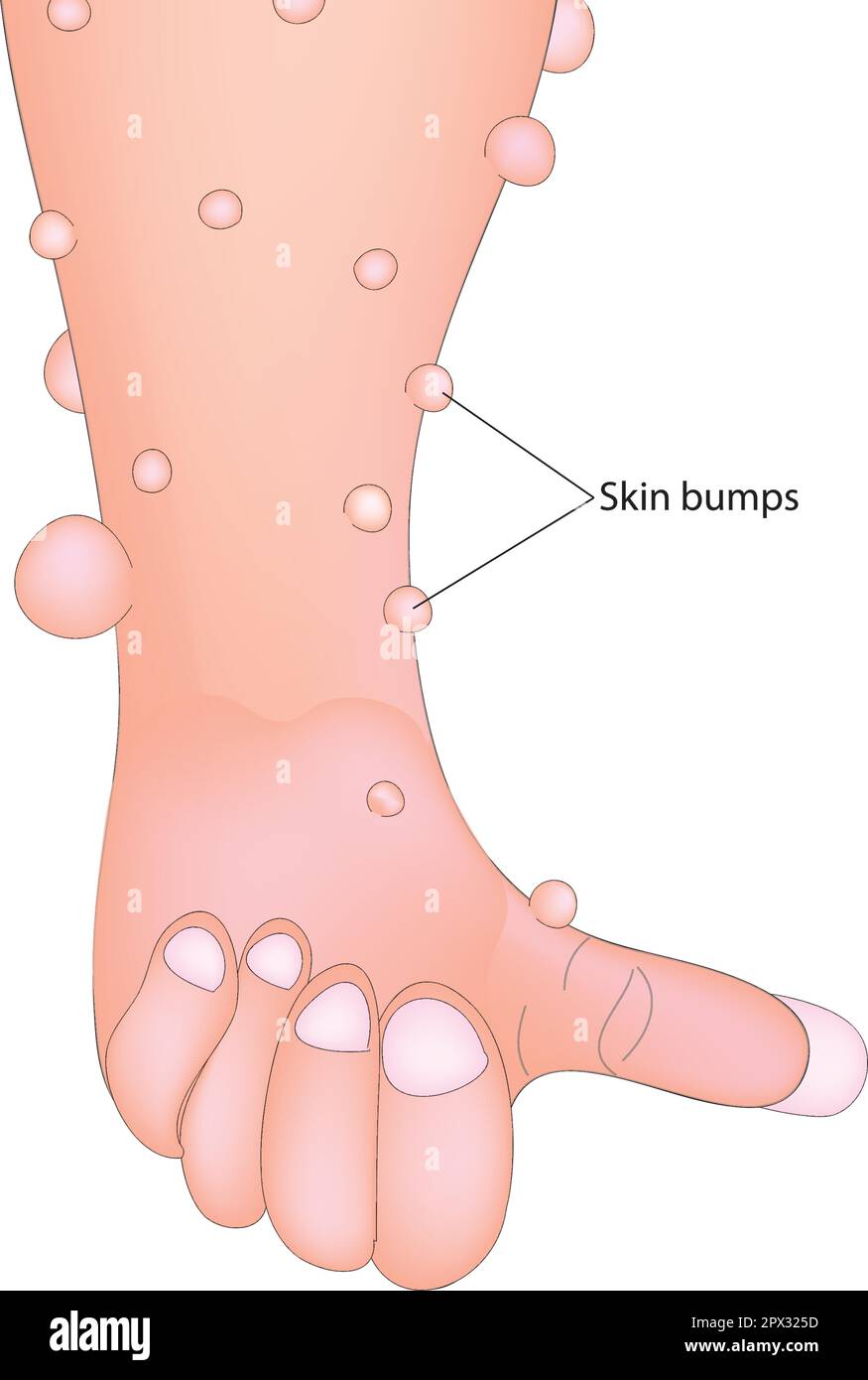 Neurofibrome Stock Vektor