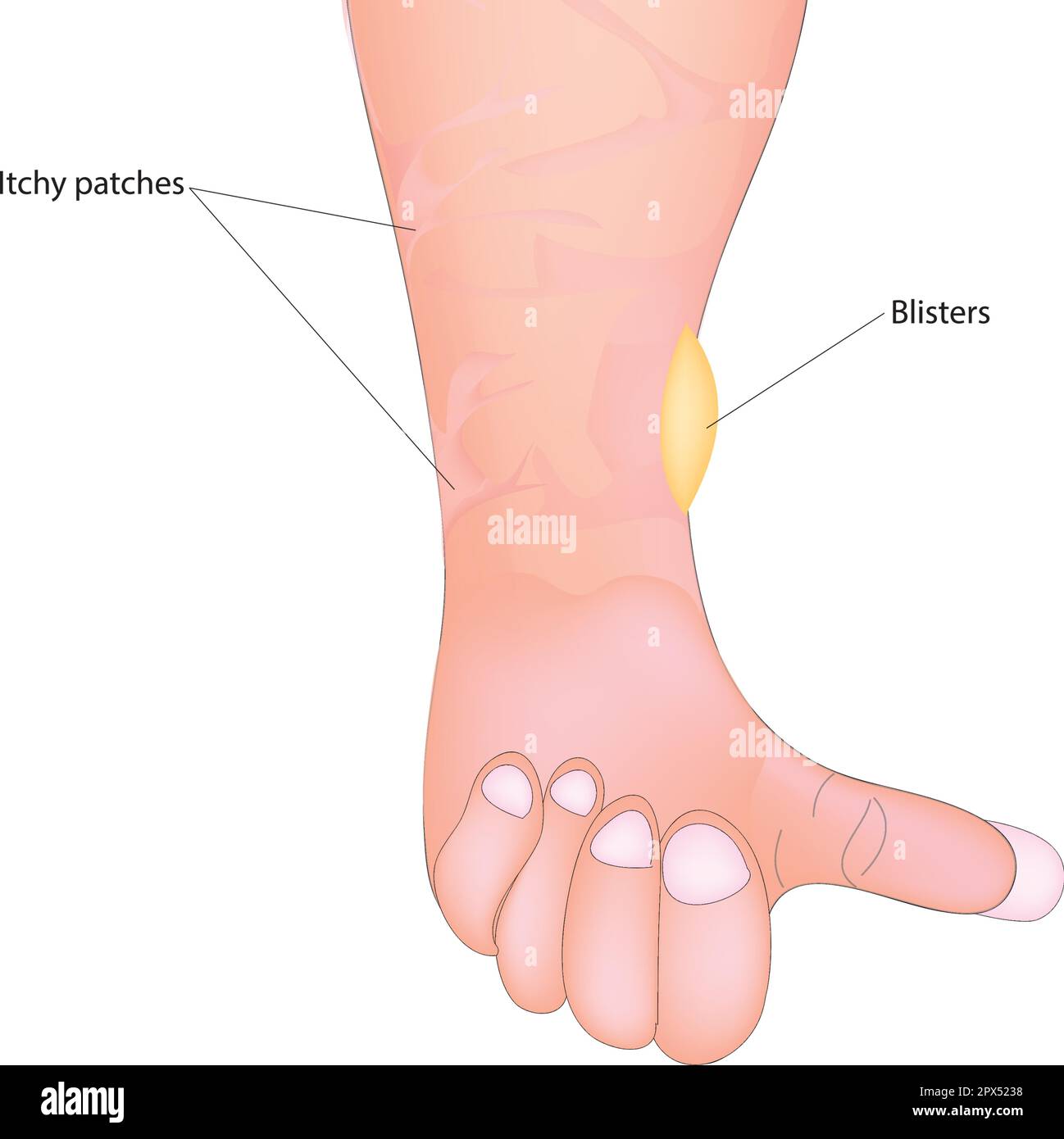 Bullöses Pemphigoid Stock Vektor