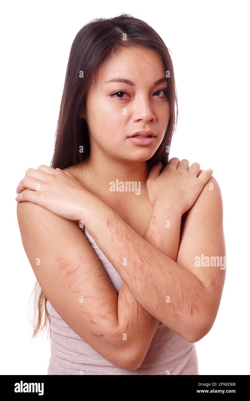 Weinende junge asiatische Frau mit selbstverschuldeten Schnitten an ihren Armen Stockfoto