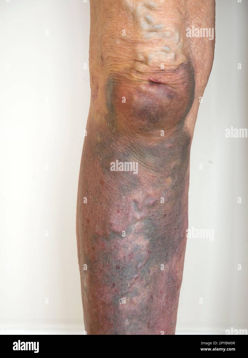 Schwere Blutergüsse am rechten Bein der Frau mit tiefen lila Blutergüssen vom Knie bis zum Fuß UK Stockfoto