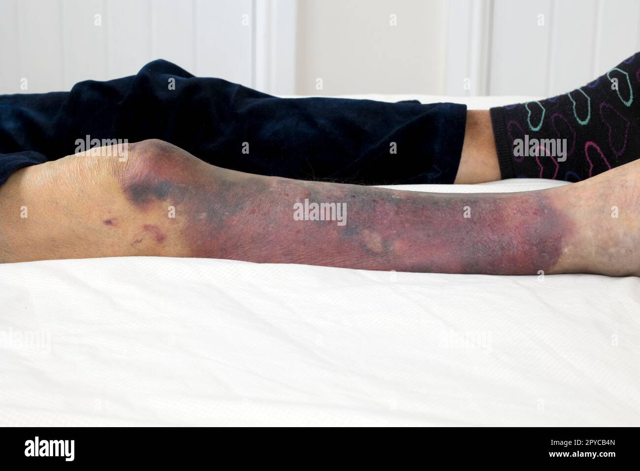 Schwere Blutergüsse am rechten Bein einer Frau nach einem Sturz mit tiefen lila Blutergüssen vom Knie bis zum Fuß UK Stockfoto