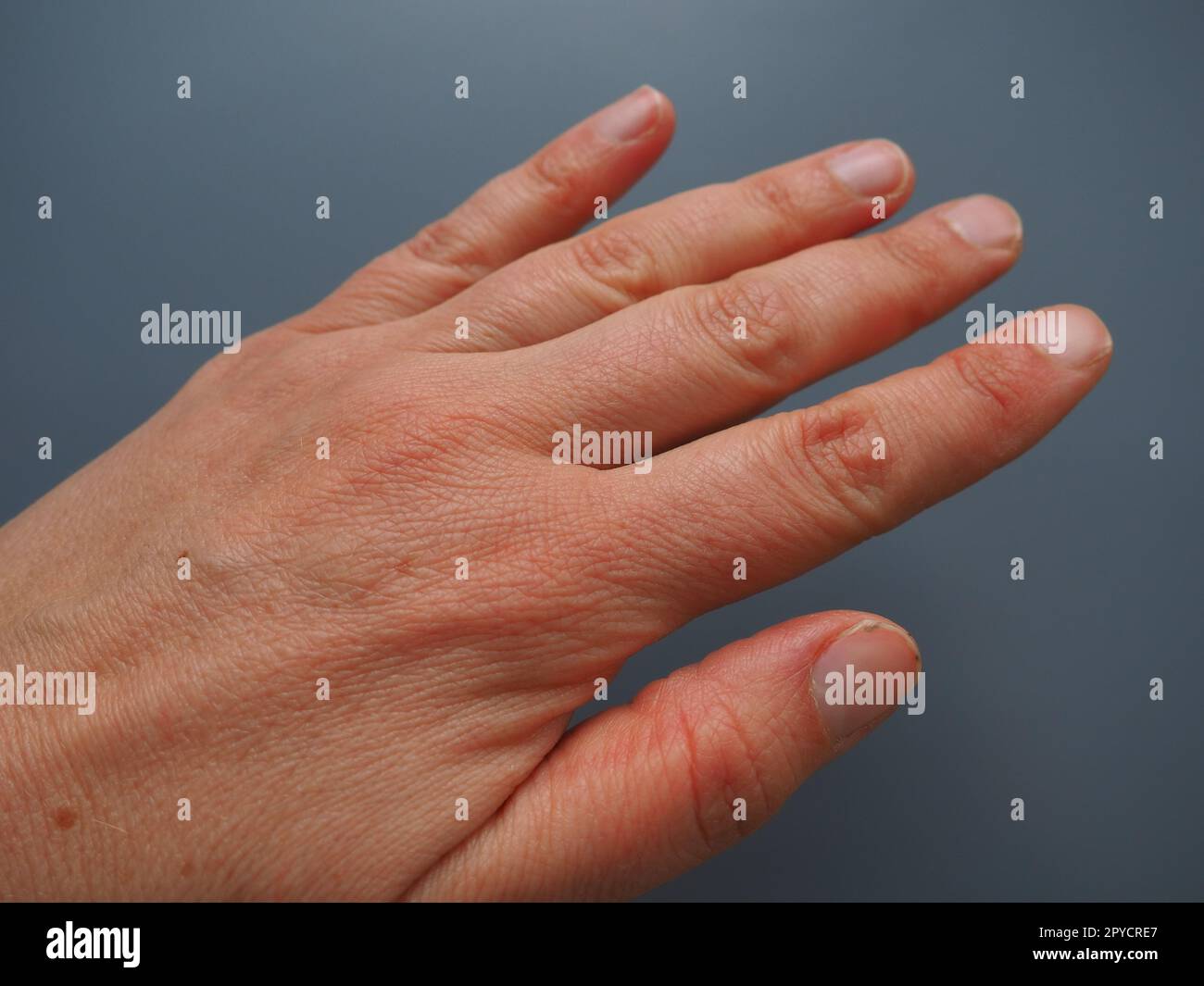 Weibliche Hand mit trockener atopischer Haut. Weißer Hintergrund. Nahaufnahme der Haut an Handfläche und Fingern. Pflegebedürftige Derma und Hydratation. Dermatologische Probleme. Unlackierte natürliche Nägel Stockfoto