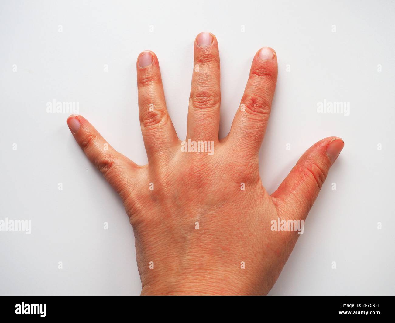 Hand auf weißem Hintergrund. Erhobene Hand. Stimmen Sie ab und bitten Sie um Hilfe. Dermatologische Probleme, trockene, dehydrierte Haut. Handbewegung Stockfoto