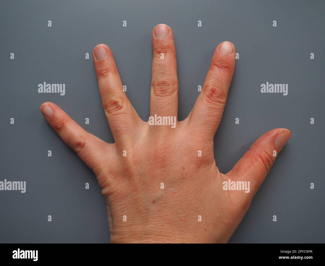 5 Finger spreizen. Weibliche Hand mit trockener atopischer Haut. Weißer Hintergrund. Nahaufnahme der Haut an Handfläche und Fingern. Pflegebedürftige Derma und Hydratation. Dermatologische Probleme. Grauer Hintergrund. Stockfoto