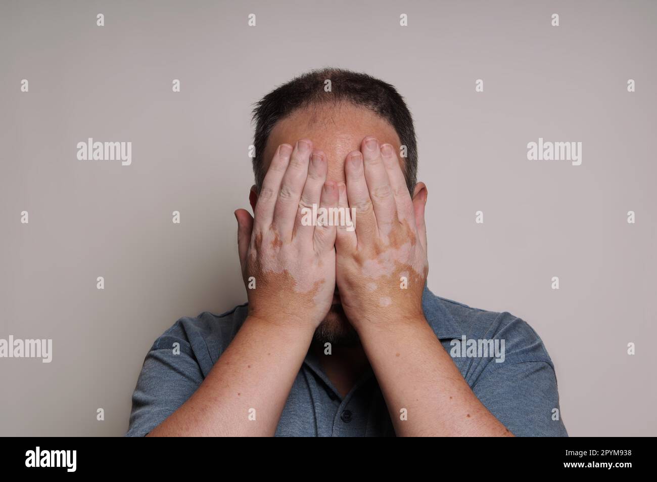 Mann von Vitiligo Hauterkrankung versteckt sein Gesicht betroffen Stockfoto