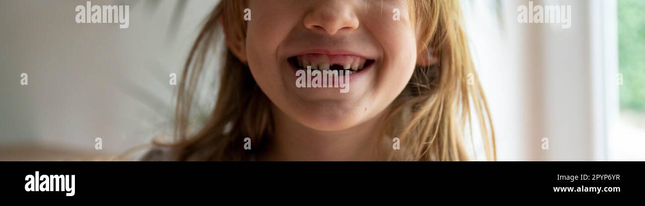Nahaufnahme eines niedlichen Kleinkindes, das lächelt und zwei Milchzähne fehlt. Weitwinkelbild. Stockfoto
