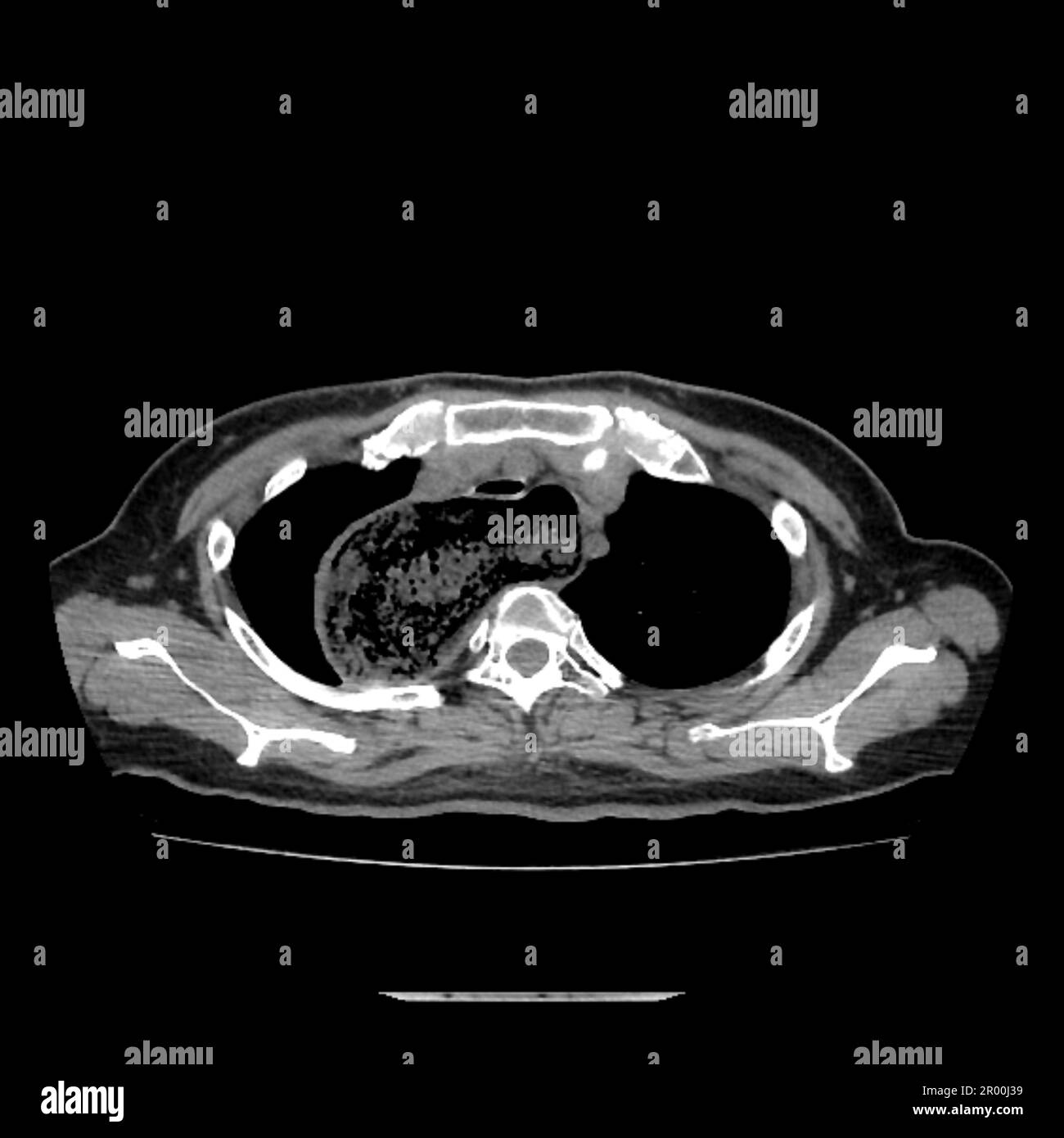 Achalasie der Speiseröhre, CT-Scan Stockfoto