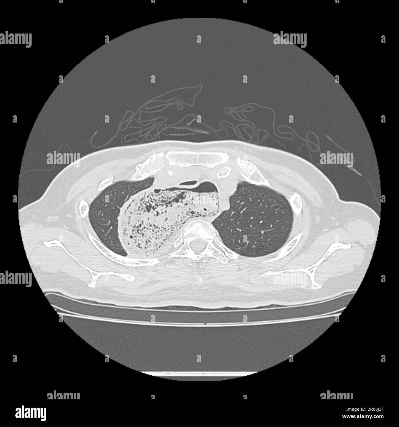 Achalasie der Speiseröhre, CT-Scan Stockfoto