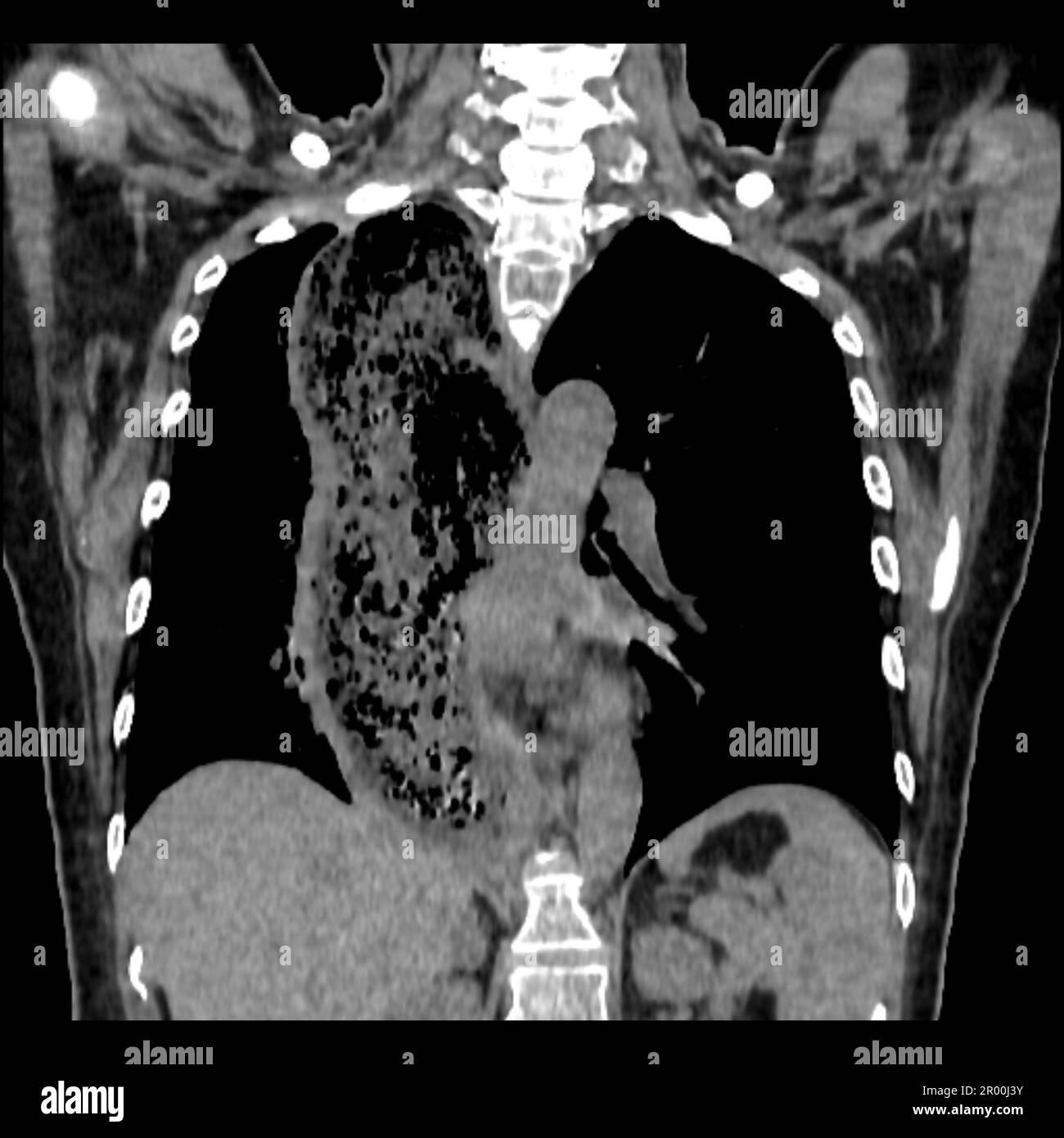Achalasie der Speiseröhre, CT-Scan Stockfoto
