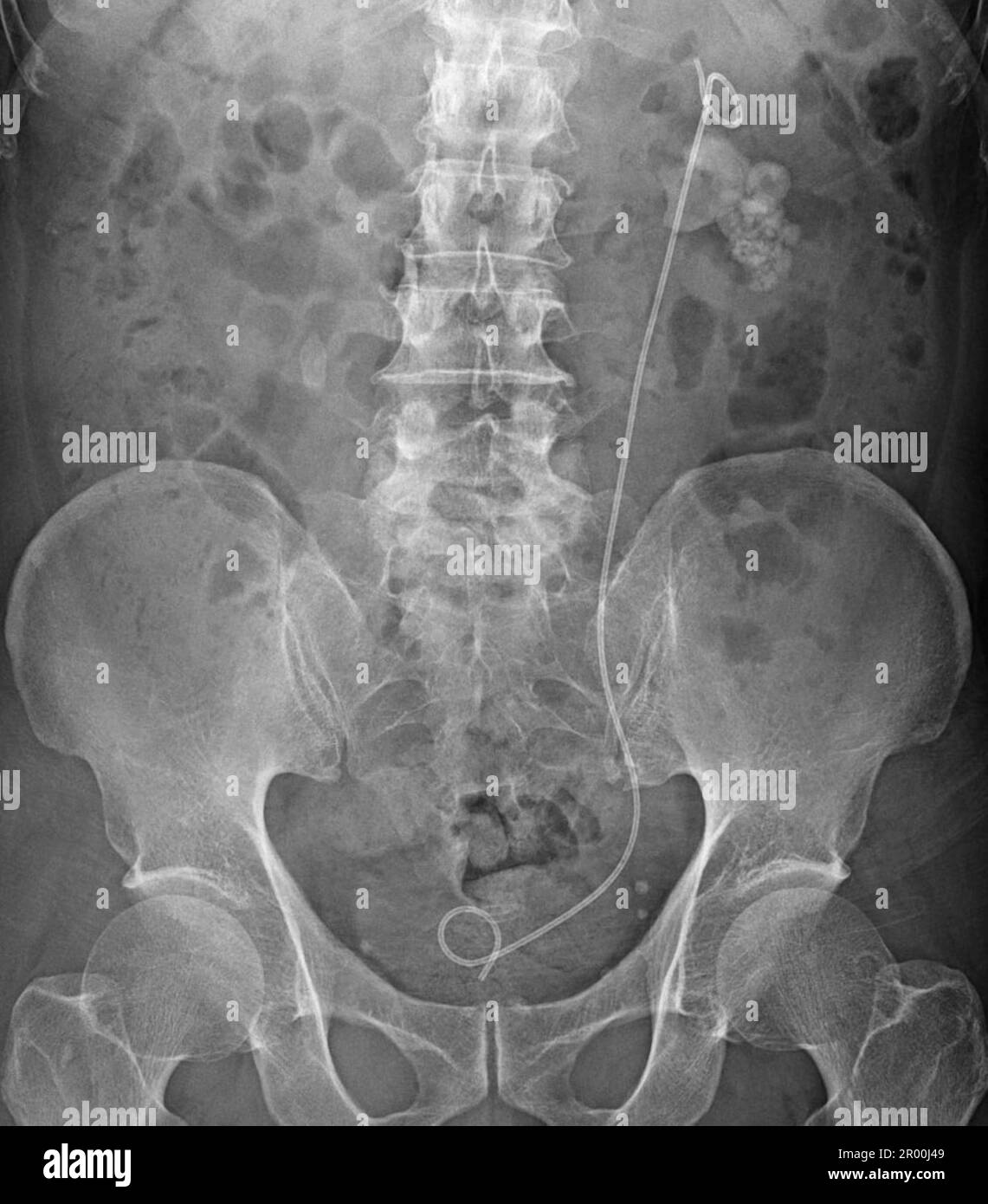 Harnsystem-Stent, Röntgen Stockfoto