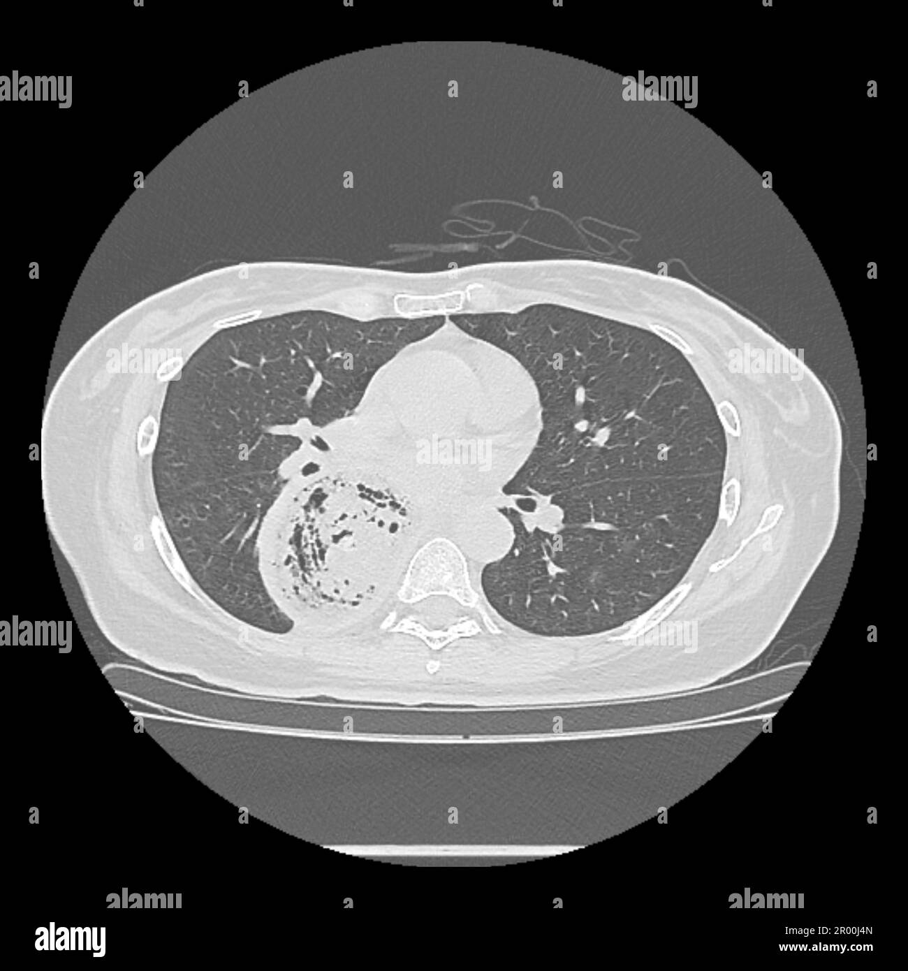 Achalasie der Speiseröhre, CT-Scan Stockfoto