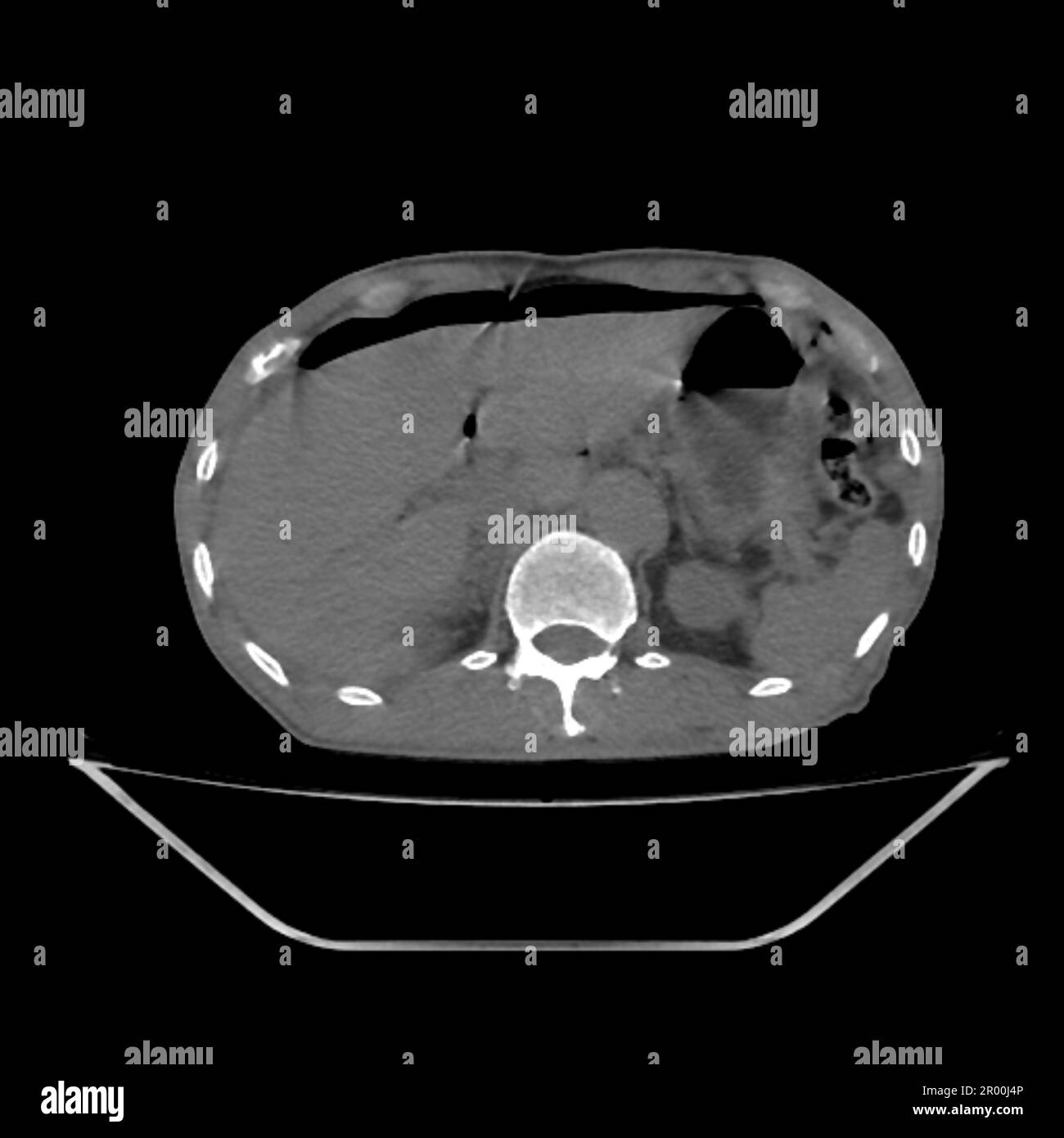 Pneumoperitoneum, CT-Scan Stockfoto
