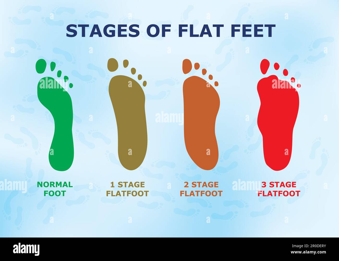 Informatives Poster über flache Füße, verschiedene Stadien der Krankheit. Stock Vektor