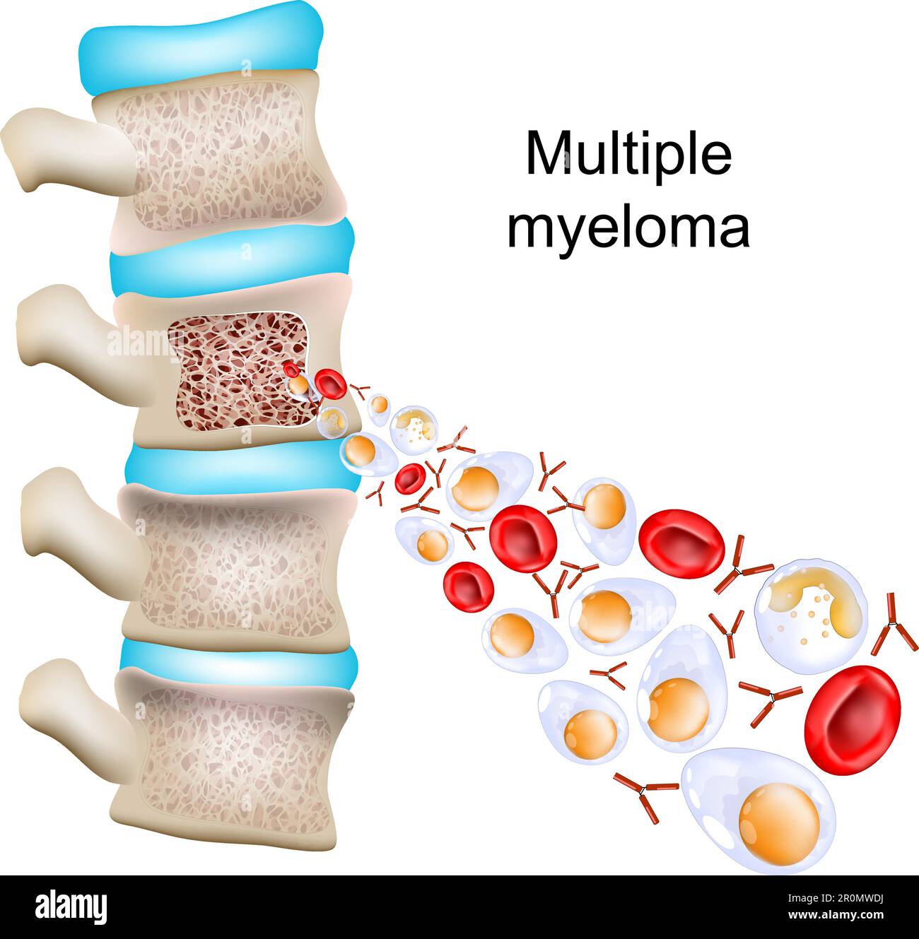 Multiples Myelom. Teil einer Wirbelsäule mit Querschnitt eines Wirbels mit Knochenstruktur und Knochenmark. Nahaufnahme abnormer Plasmazellen, Stock Vektor
