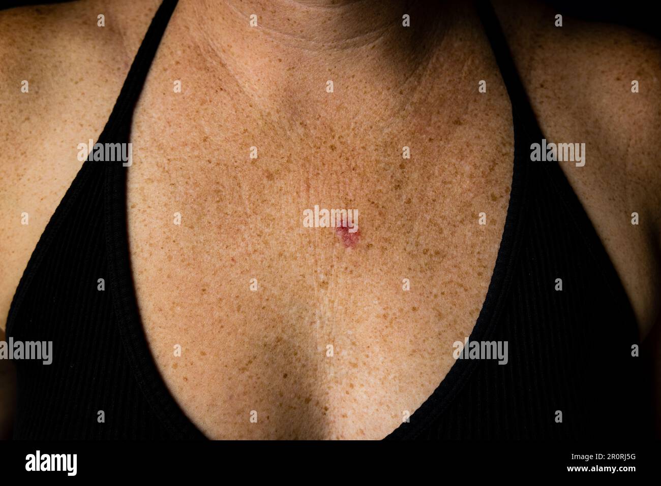 Horizontalansicht des Basalzellkarzinoms auf der jungen 30s-kaukasischen weiblichen Brust. Stockfoto