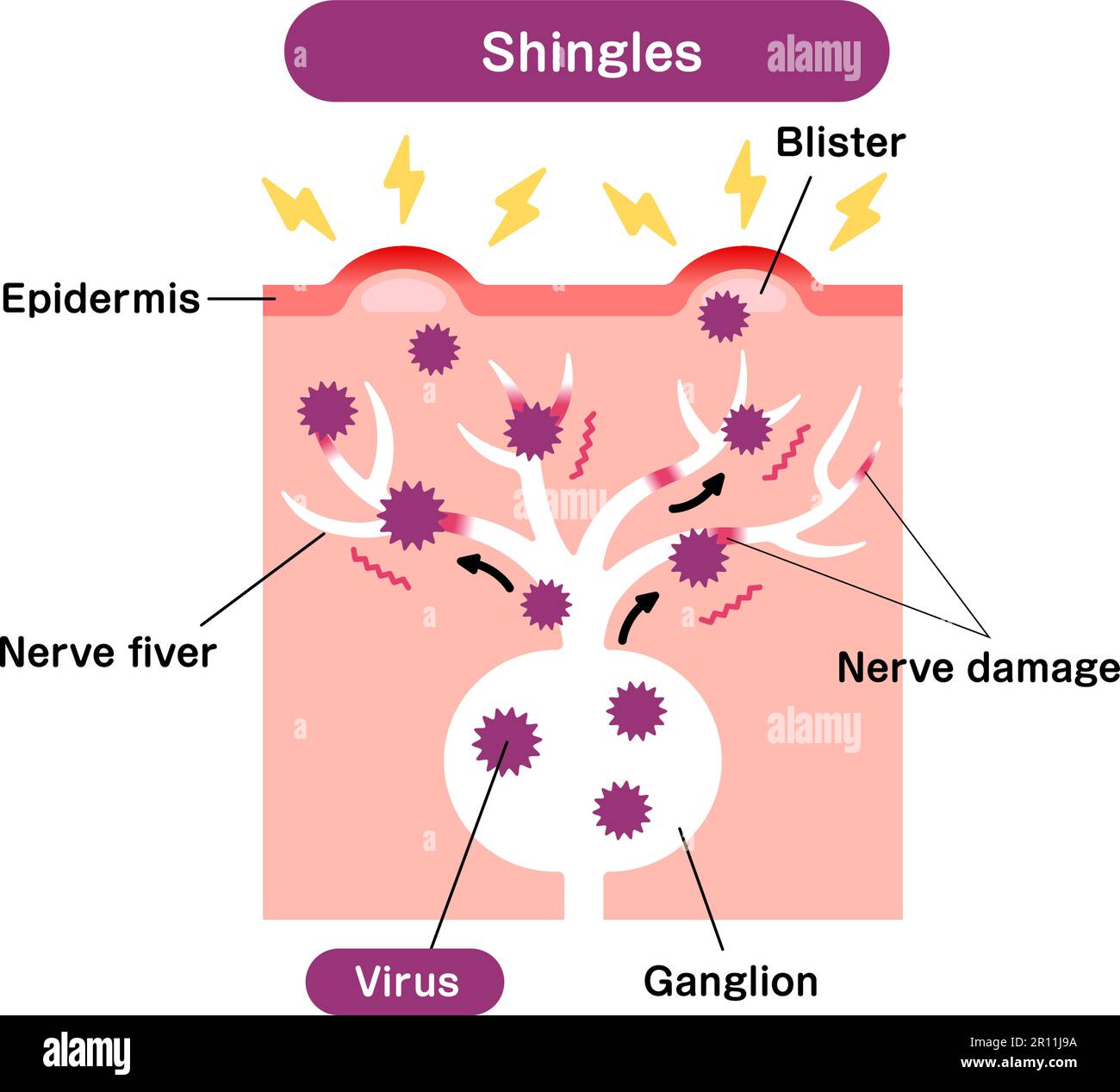 Vektordarstellung zum Mechanismus der Gürtelrose ( Herpes zoster ) Stock Vektor