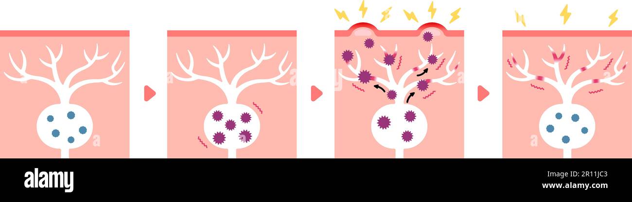 Vektordarstellung des Mechanismus der Gürtelrose ( Herpes zoster ) (einschließlich postherpetischer Neuralgie) Stock Vektor