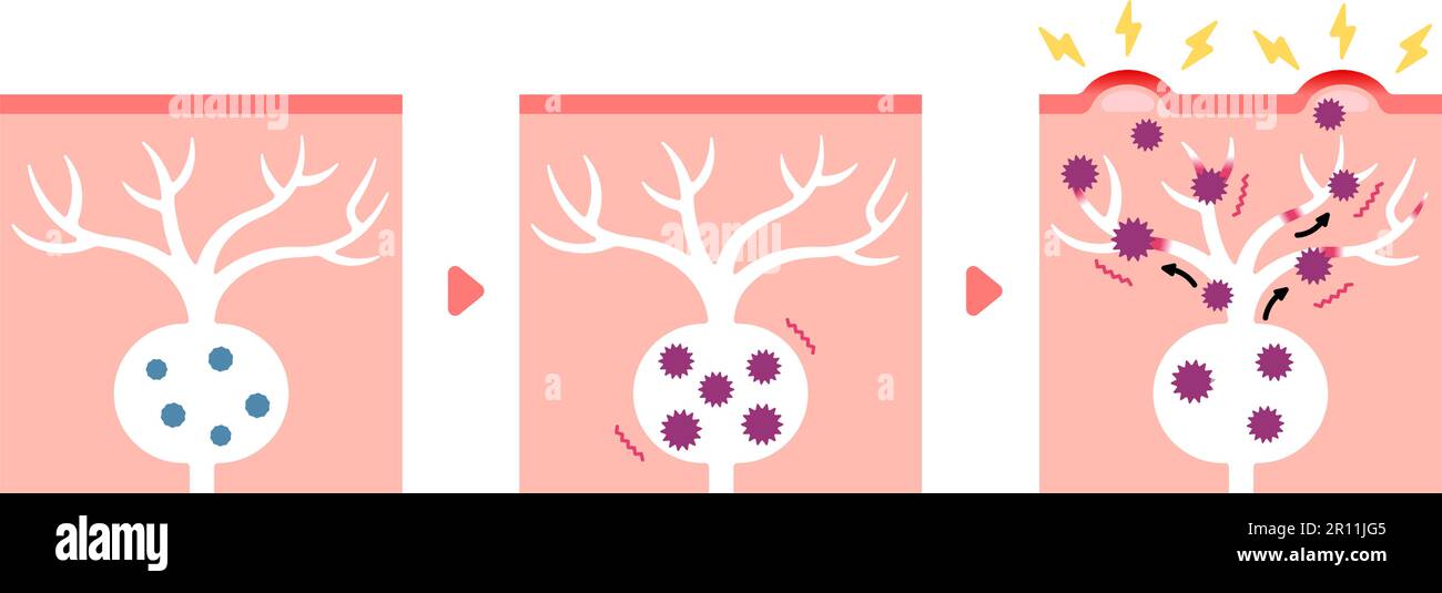 Vektordarstellung zum Mechanismus der Gürtelrose ( Herpes zoster ) Stock Vektor