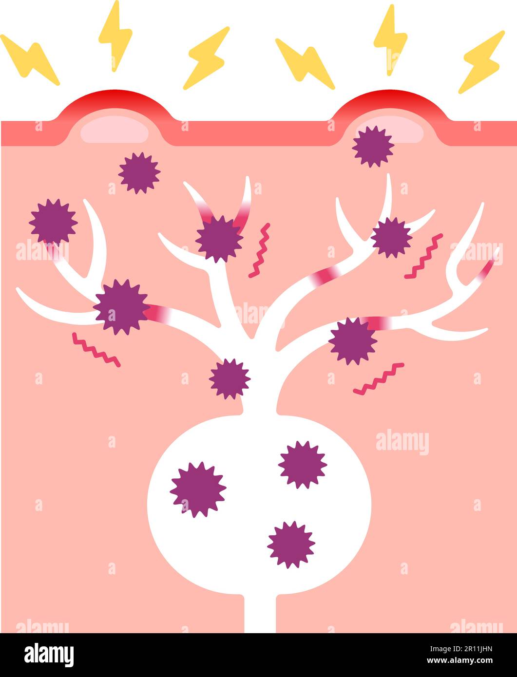 Herpes zoster hautausschlag Stock-Vektorgrafiken kaufen - Alamy