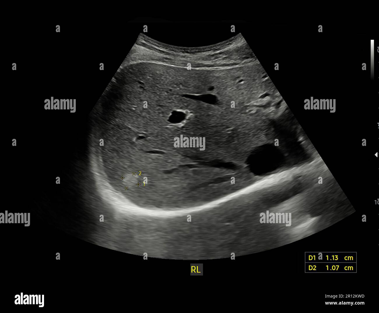 Ultraschall Oberbauch zur Diagnostik von Bauchschmerzen. Stockfoto