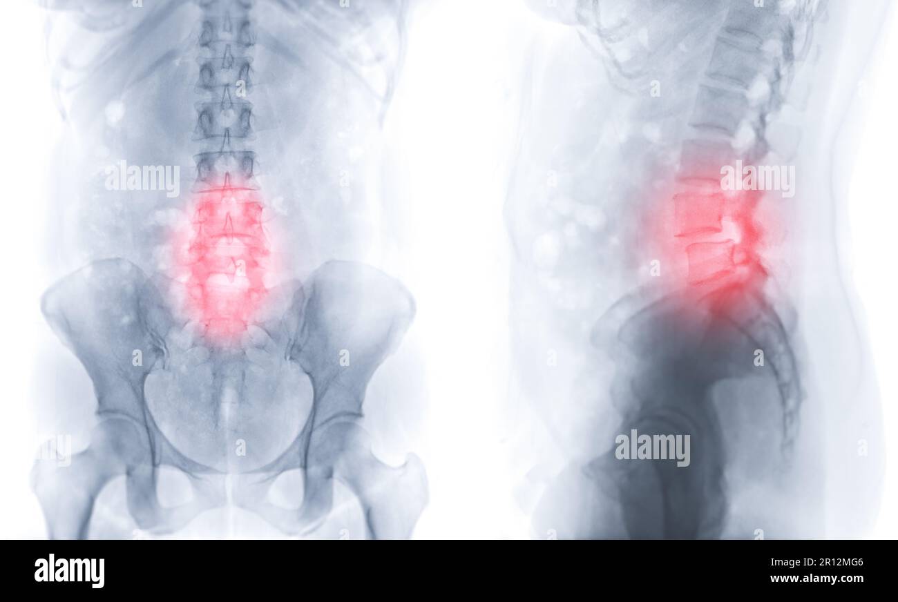 Röntgenbild der Lendenwirbelsäule oder L-S-Wirbelsäule AP und laterale Ansicht zur Diagnose von Schmerzen im unteren Rücken. Stockfoto